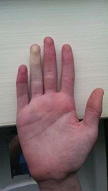 Example of Raynaud's phenomenon, viewed from the front of the hand