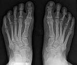 Severe bunion deformity correction without breaking bones or joint fusions was not deemed possible before osteodesis and syndesmosis procedures