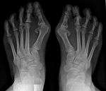 Severe hallux valgus deformity