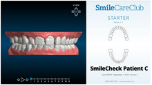 This is an example of a SmileCareClub treatment plan for spacing