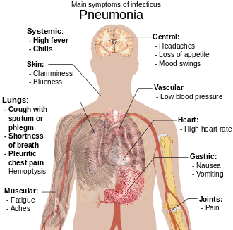 Illustration of pneumonia symptoms on a human body