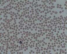 A picture of the blood under a microscopy showing thrombocytopenia