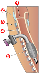 Diagram of a tracheostomy tube in the trachea