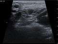 Ultrasound image Cystic Hygroma 20171221546 17F.jpg