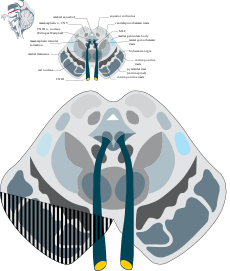 Weber's syndrome.svg