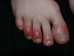 Redness and swelling of the distal toes