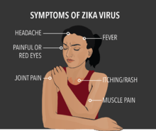Symptoms of Zika virus