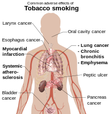 head and torso of a male with internal organs shown and labels referring to the effects of tobacco smoking