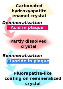 Carbonated hydroxyapatite enamel crystal is demineralized by acid in plaque and becomes partly dissolved crystal. This in turn is remineralized by fluoride in plaque to become fluorapatite-like coating on remineralized crystal