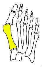 First metatarsal bone has moved aside