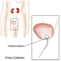 Foley Catheter Illustration