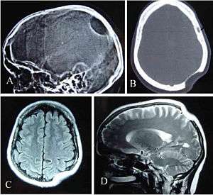 Skull x-rays of Gorham's disease