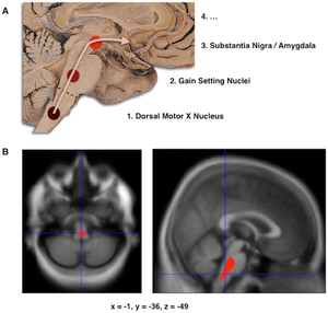 Composite of three images, one in top row (referred to in caption as A), two in second row (referred to as B). Top shows a mid-line sagittal plane of the brainstem and cerebellum. There are three circles superimposed along the brainstem and an arrow linking them from bottom to top and continuing upward and forward towards the frontal lobes of the brain. A line of text accompanies each circle: lower is "1. Dorsal Motor X Nucleus", middle is "2. Gain Setting Nuclei" and upper is "3. Substantia Nigra/Amygdala". The fourth line of text above the others says "4. ...". The two images at the bottom of the composite are magnetic resonance imaging (MRI) scans, one sagittal and the other transverse, centred at the same brain coordinates (x=-1, y=-36, z=-49). A colored blob marking volume reduction covers most of the brainstem.