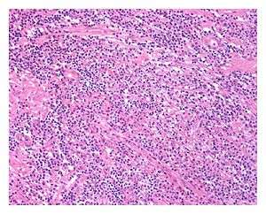 Low power view of IgG4-related prostatitis