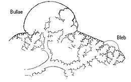 A schematic drawing showing a bulla and a bleb, two lung abnormalities that can lead to pneumothorax