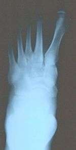 Severe metatarsus primus varus deformity