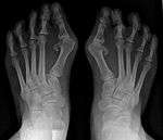 Severe hallux valgus deformity