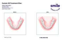 This is an example of a SmileDirectClub bottom teeth 3D treatment plan