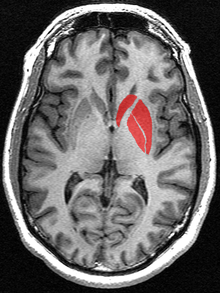 The striatum as seen on MRI. The striatum includes the caudate nucleus and putamen. The image also includes the globus pallidus, which is sometimes included when using the term corpus striatum.