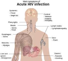 A diagram of a human torso labelled with the most common symptoms of an acute HIV infection