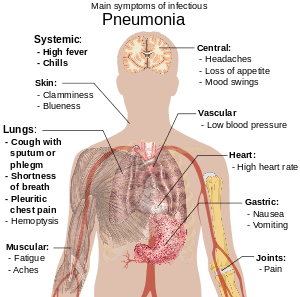 A diagram of the human body outlining the key symptoms of pneumonia