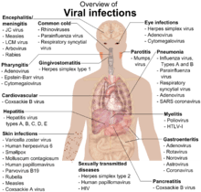 A photograph of the upper body of a man labelled with the names of viruses that infect the different parts