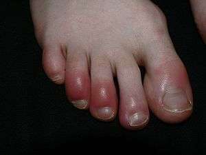 Redness and swelling of the distal toes